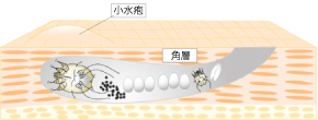 疥癬トンネル