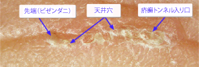 疥癬トンネル